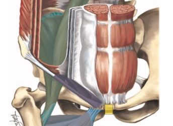 Causas de dolor de cadera, dolor inguinal relacionado con el ligamento inguinal