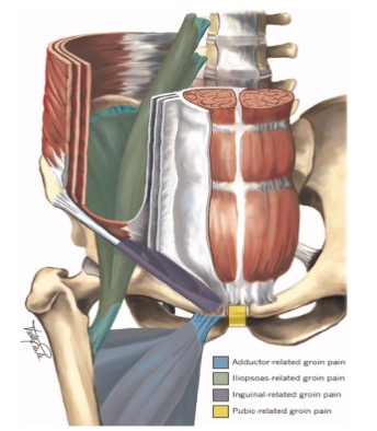 Causas de dolor de cadera, dolor inguinal relacionado con el ligamento inguinal
